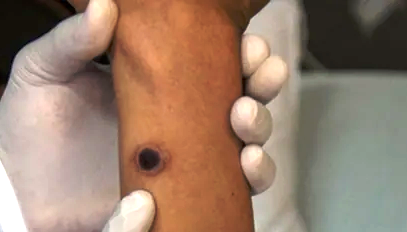 Язва при оспе обезьян - Евромедклиник (Жулебино)