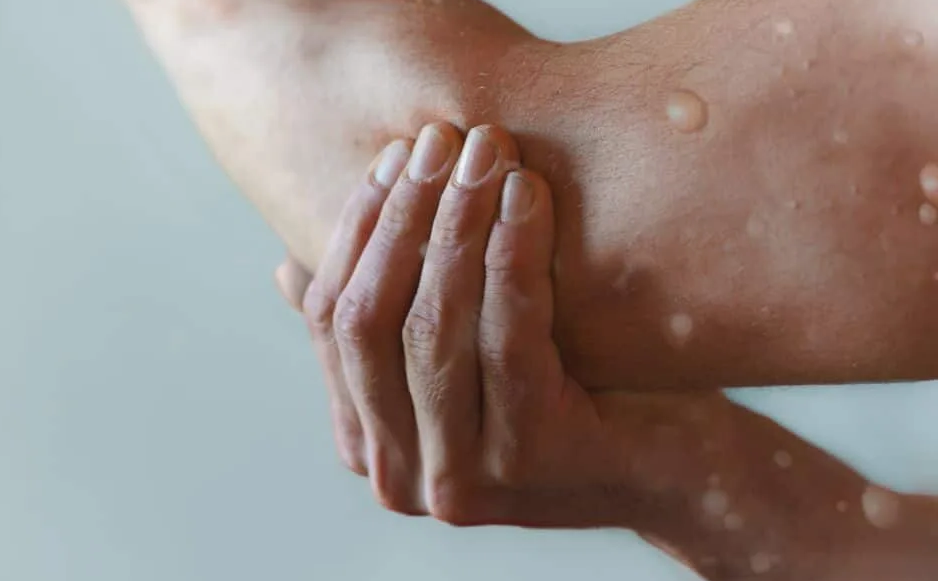 Папула при оспе обезьян - Евромедклиник (Жулебино)