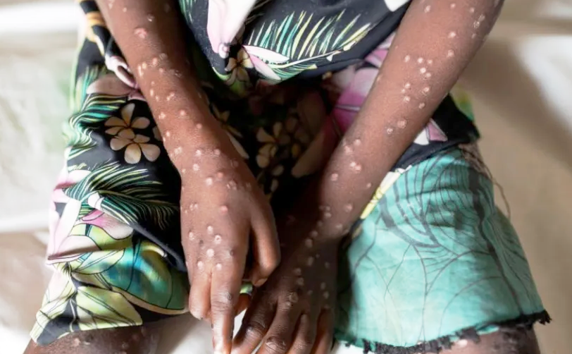 Как выглядит оспа обезьян - Евромедклиник (Жулебино)